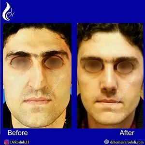 جراحی درمانی بینی - دکتر رشدی