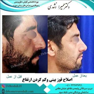 جراحی بینی در تبریز - دکتر حمیرا رشدی