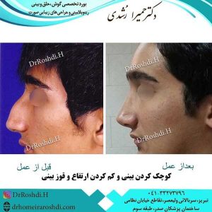 جراحی بینی در تبریز - دکتر رشدی