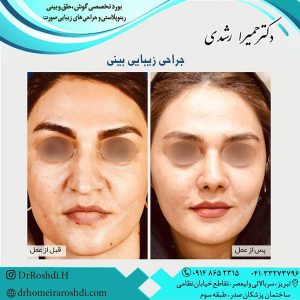جراحی زیبایی بینی در تبریز