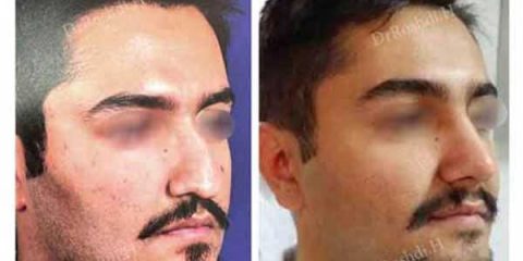 جراحی بینی در تبریز