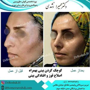 جراحی زیبایی بینی در تبریز - دکتر رشدی