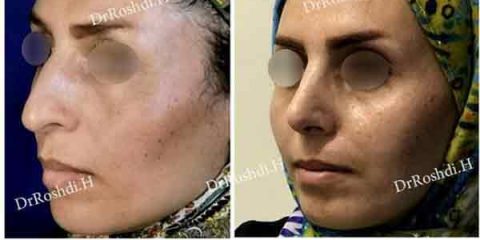 جراحی زیبایی بینی در تبریز