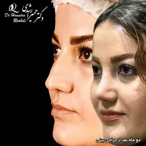 جراحی بینی استخوانی