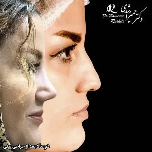 جراحی بینی استخوانی