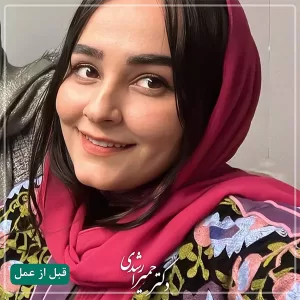جراحی بینی فانتزی در تبریز - دکتر حمیرا رشدی