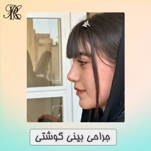 جراحی بینی گوشتی در تبریز - دکتر حمیرا رشدی