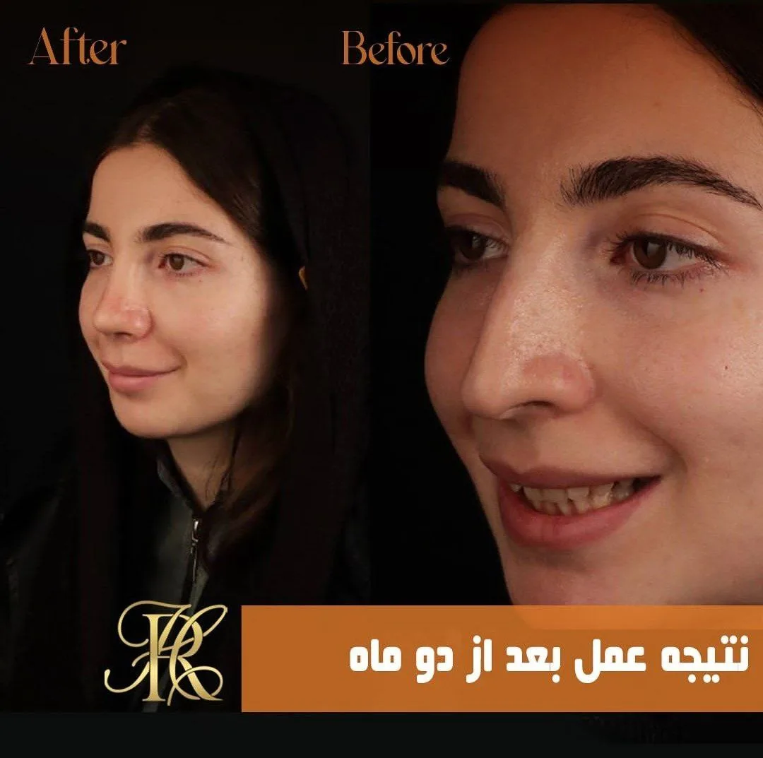 جراحی بینی استخوانی - دکتر حمیرا رشدی