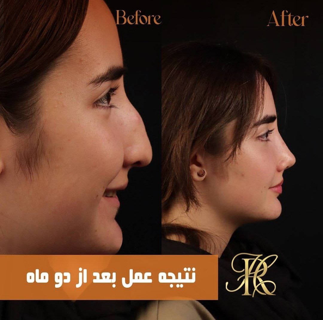 جراحی بینی استخوانی - دکتر حمیرا رشدی