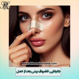 جابجایی غضروف بینی بعد از عمل - دکتر حمیرا رشدی