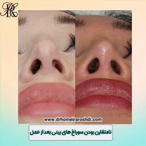 عدم تقارن سوراخهای بینی بعد از جراحی - دکتر حمیرا رشدی