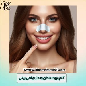 کامپوزیت دندان بعد از جراحی بینی - دکتر حمیرا رشدی