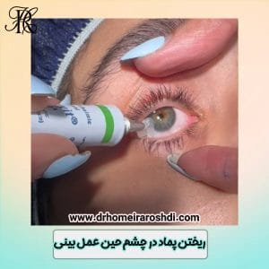 ریختن پماد در چشم حین عمل بینی - دکتر حمیرا رشدی