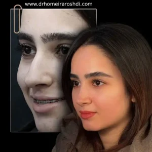نمونه کارهای بهترین جراح بینی در تبریز _ دکتر حمیرا رشدی