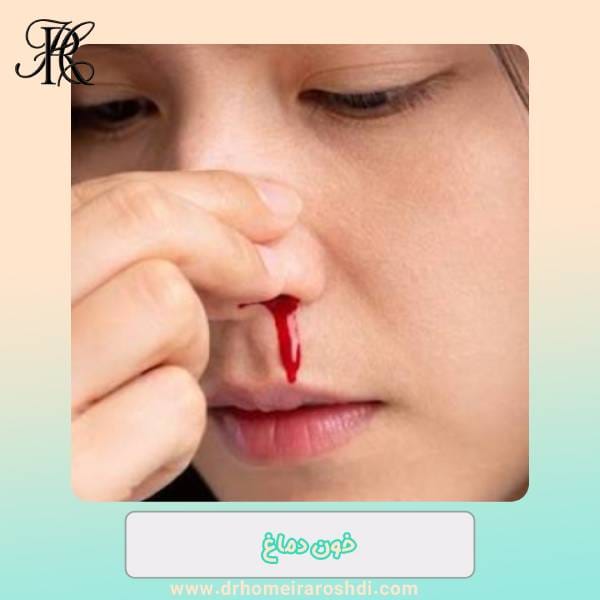 خون دماغ از سوراخ چپ بینی