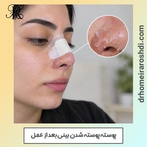 پوسته پوسته شدن بینی بعد از عمل - دکتر رشدی