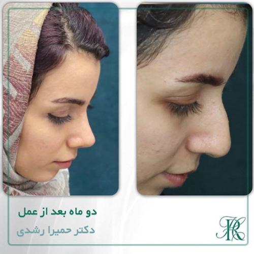 جراحی-بینی-356