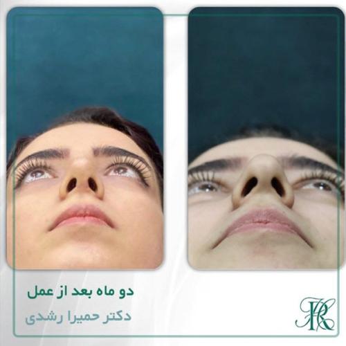 جراحی-بینی-357