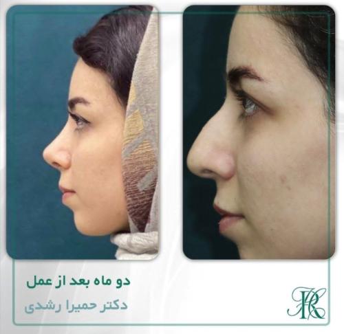جراحی-بینی-360