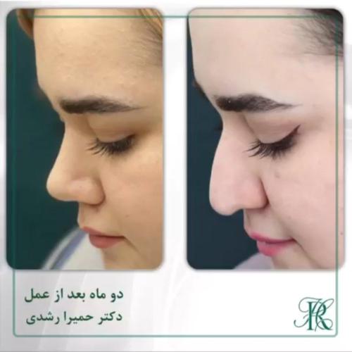 جراحی-بینی-370