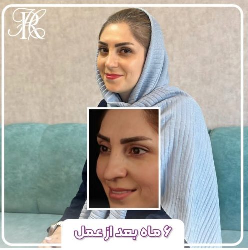 جراحی-بینی-376