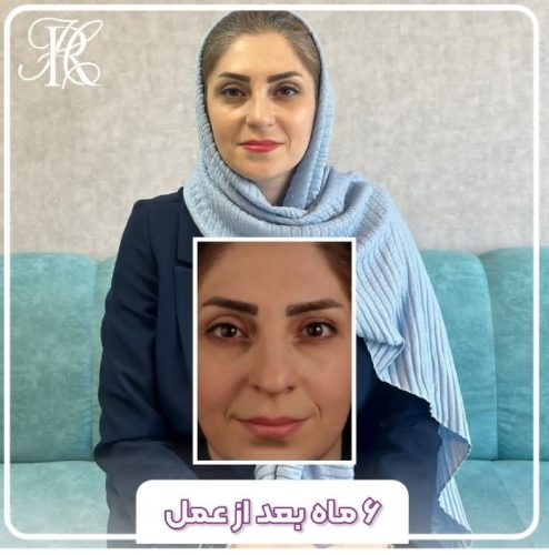 جراحی-بینی-378