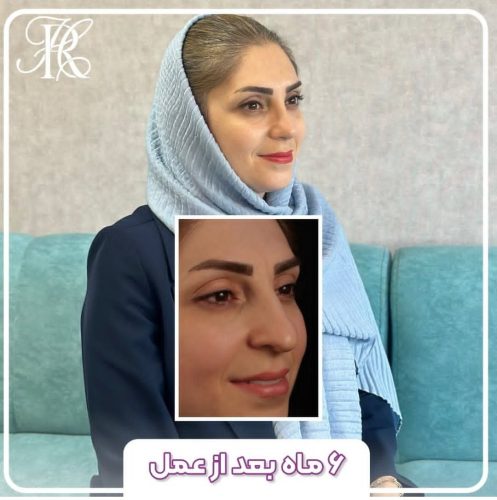 جراحی-بینی-379