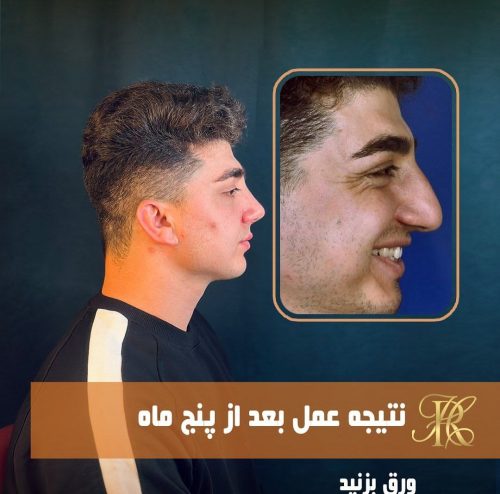 جراحی-بینی-386