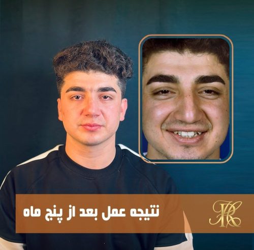 جراحی-بینی-388