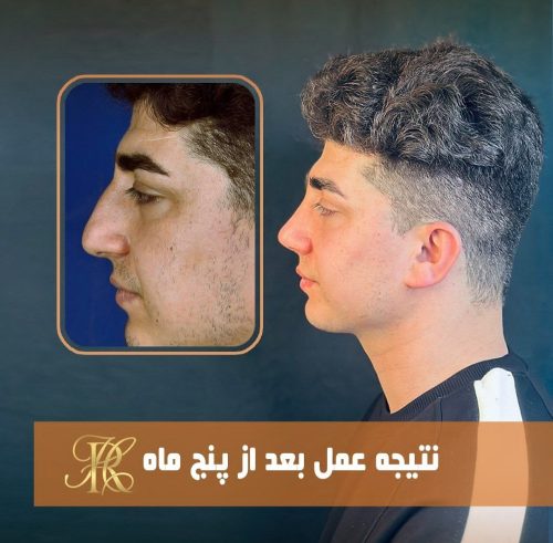جراحی-بینی-389