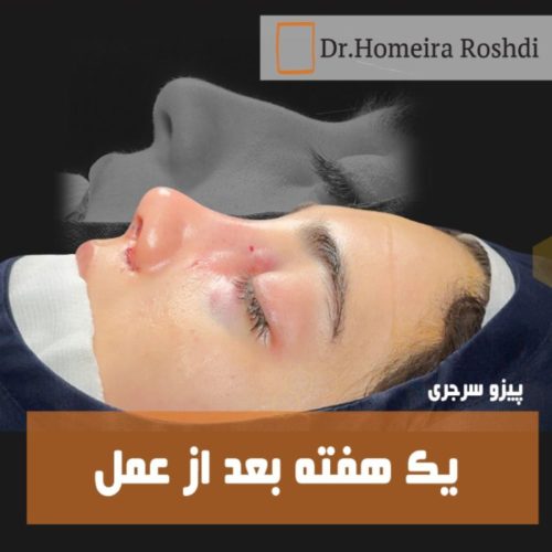 جراحی-بینی-391