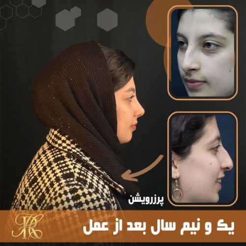 جراحی-بینی-392