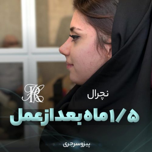 جراحی-بینی-395