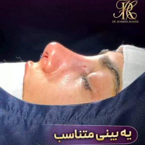 جراحی-بینی-397