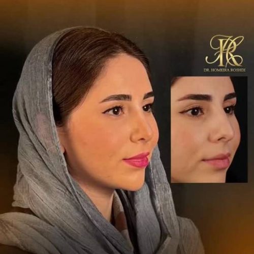 جراحی-بینی-409