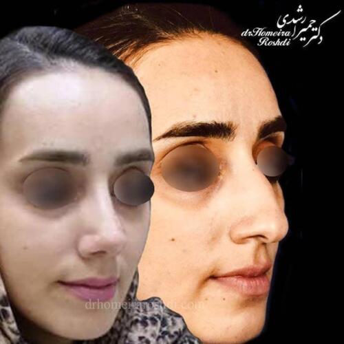 جراحی زیبایی بینی 225