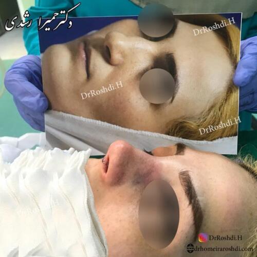 جراحی-بینی-تبریز-31