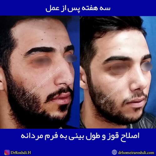 جراحی بینی تبریز 64